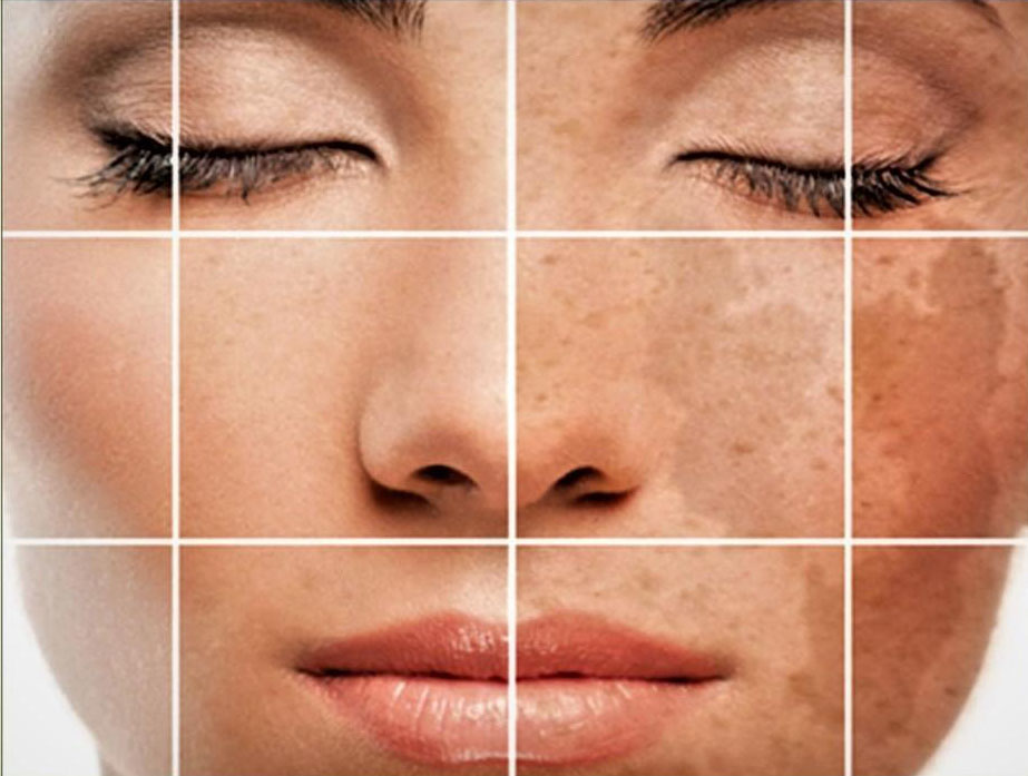 Hyperpigmentation - FullerSkin